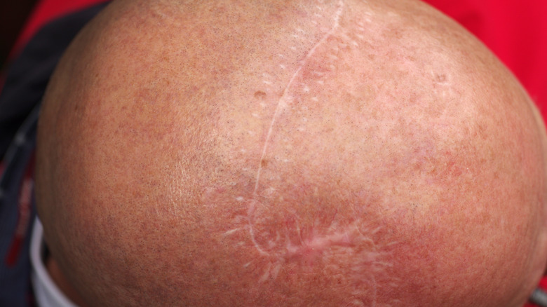 a scar on a shaved head