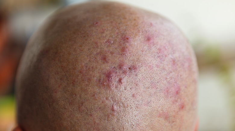 acne on a scalp