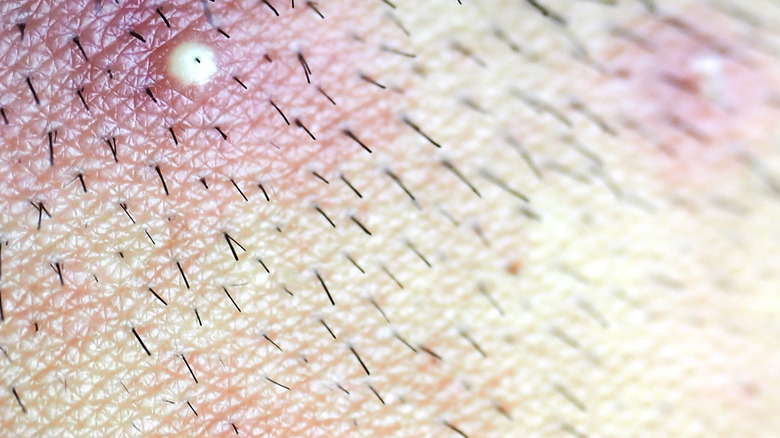 ingrown hairs on scalp