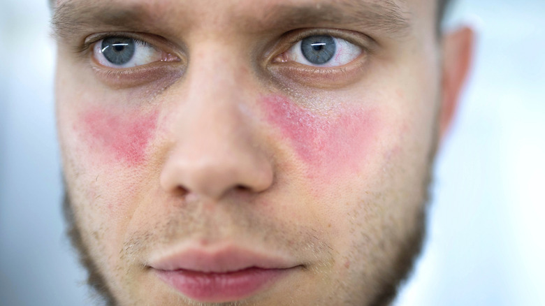 a man with a telltale lupus rash
