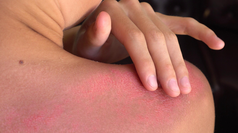 treating sunburn on shoulder