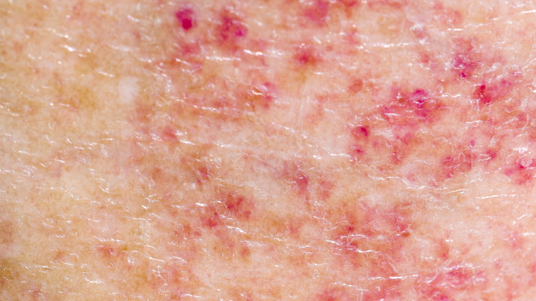 a rash caused by sun exposure