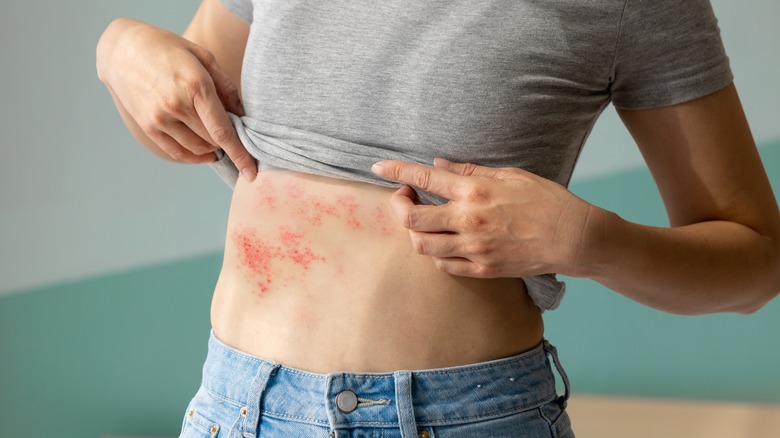 Woman with skin infection in abdomen