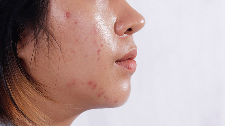 woman with facial acne