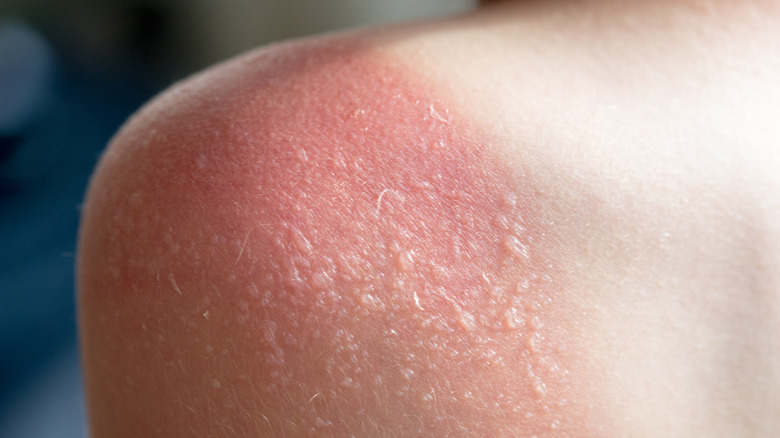 sunburn blisters on a shouler