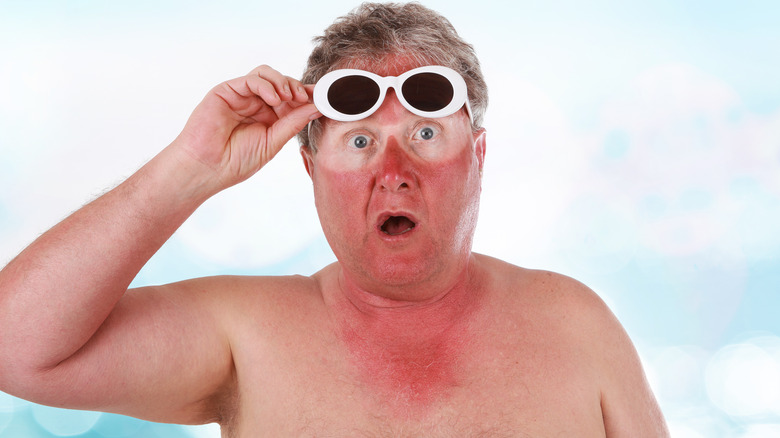 man with sunburn