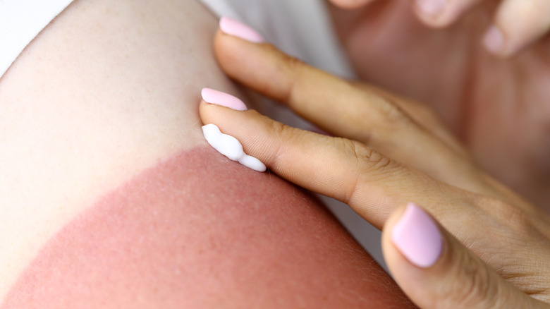 applying lotion to a sunburn