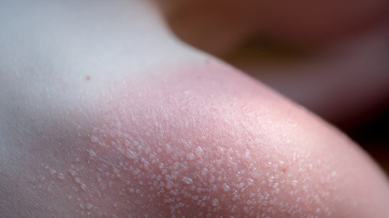 sunburn blisters on a shoulder