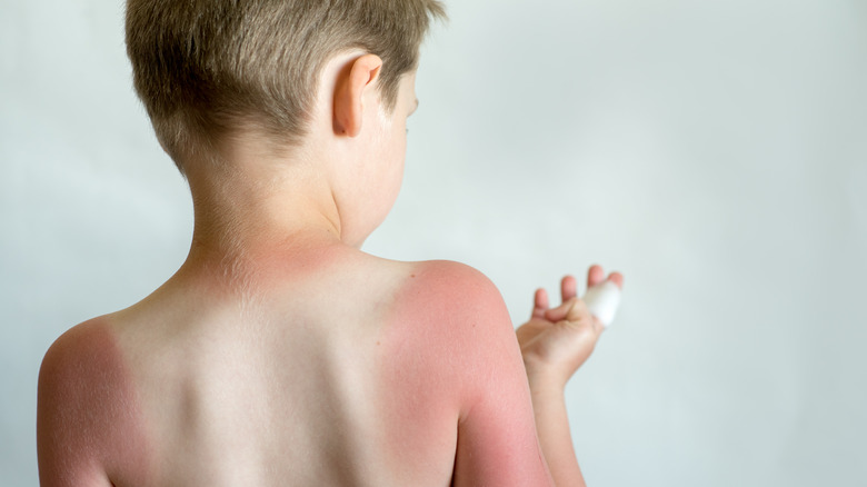 little boy with sunburn