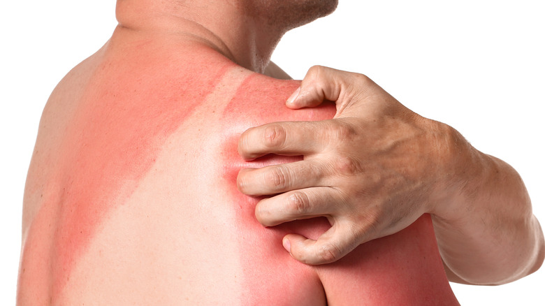 a woman scratches her sunburn