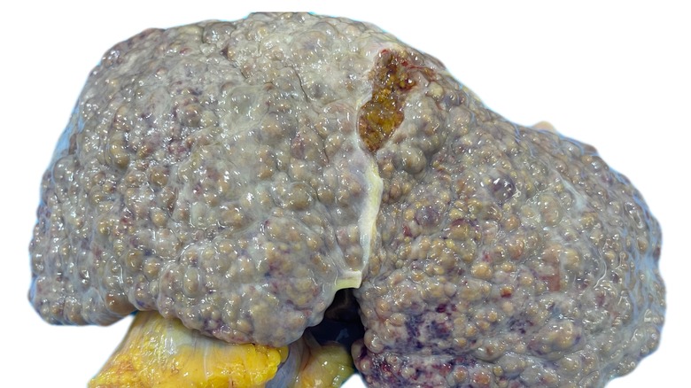 extensive liver scarring and fibrosis