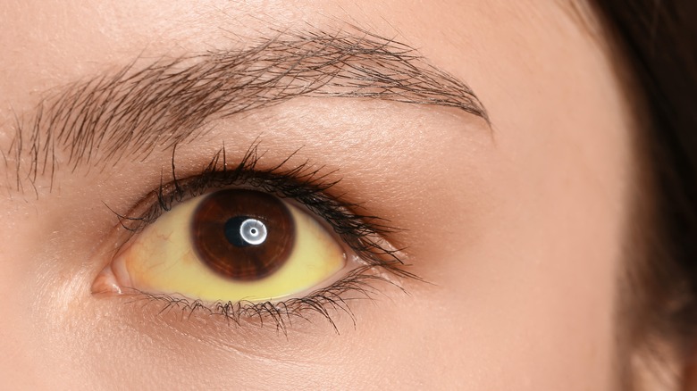 yellowing of eye in a woman