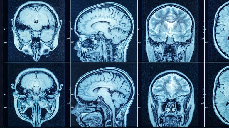 Multiple images of brain scans