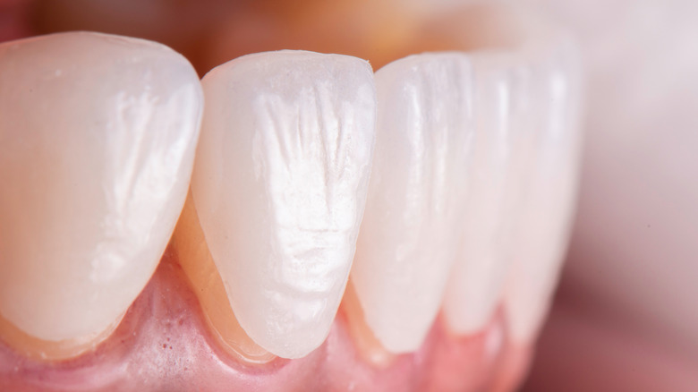 close up of visible veneers on a set of teeth 