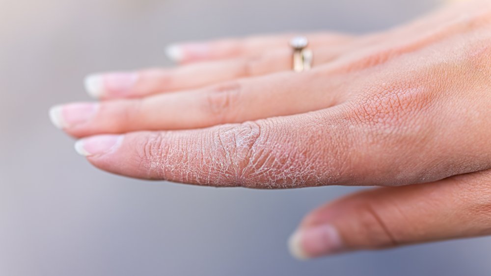 Dry hands from hand sanitizer