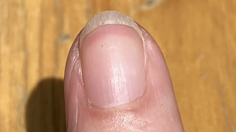 Finger with no visible lunula