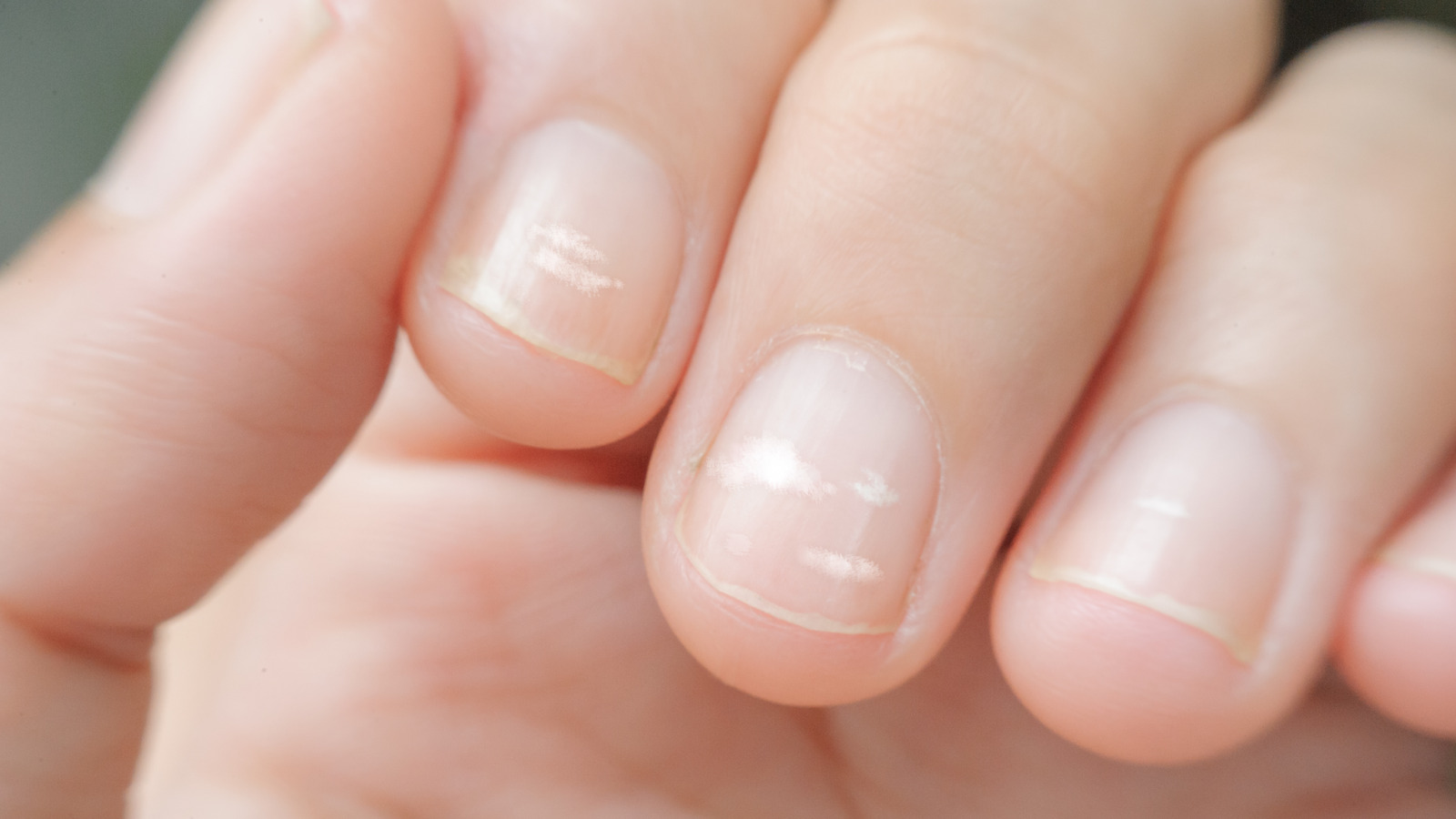 White Spots On Finger Nails Called Leukonychia Reveal The Emergence Of  Health Problems Stock Photo - Download Image Now - iStock