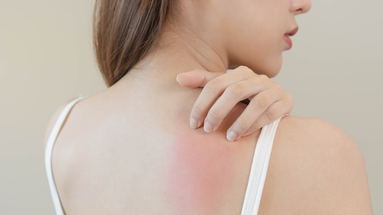 young girl hand on back with red rash on shoulder