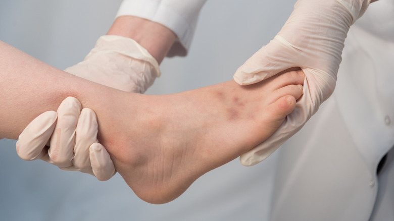 A doctor examining a bruise on a foot