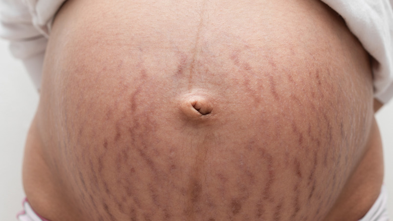 stretch marks on belly 
