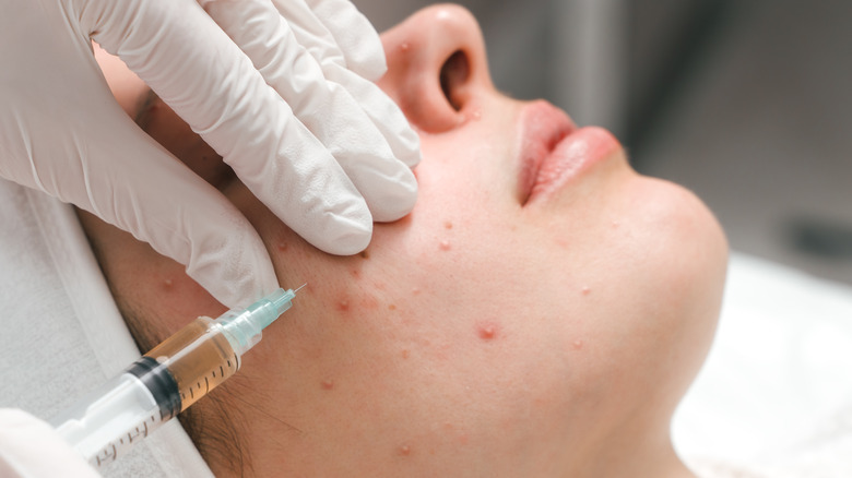 Cortisone shot injected into acne