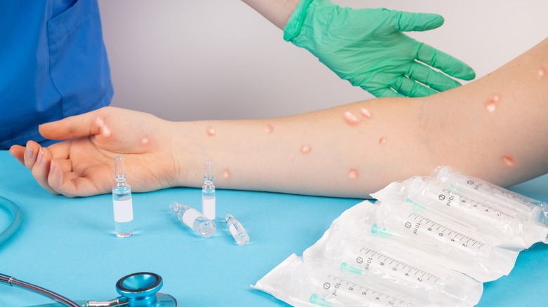 doctor examining patient's hand with monkeypox symptoms