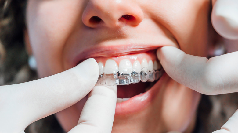 dentist placing dental aligner on woman's teeth