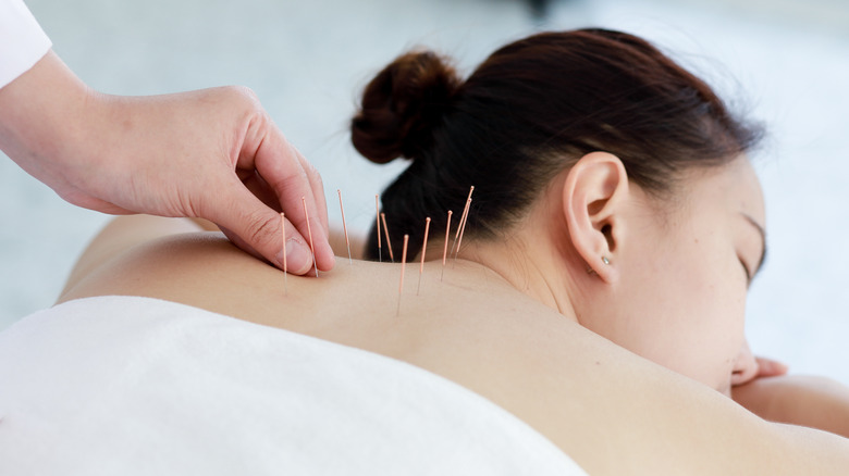 woman receiving acupuncture