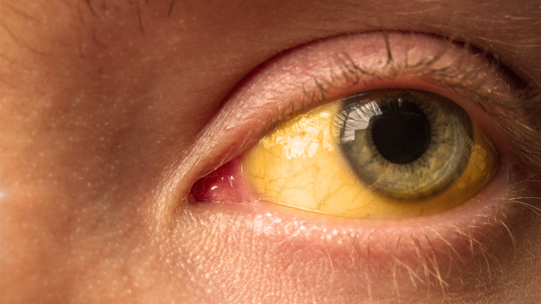 yellow sclera of eye