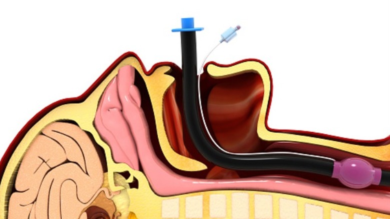 intubation