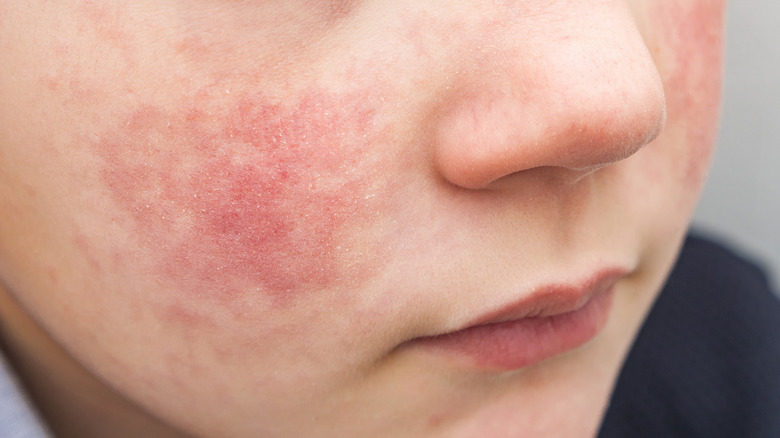 Child with a skin rash, a potential symptom of the parechovirus