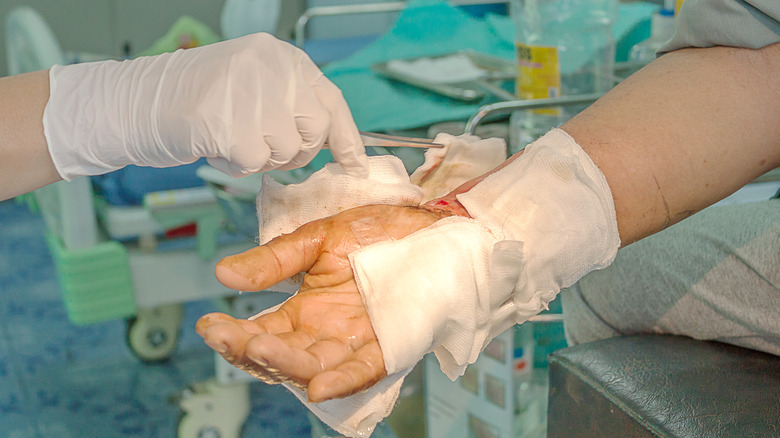 Doctor treating patient burn wound