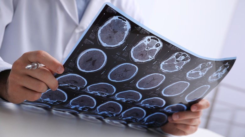 Doctor holding brain scan images