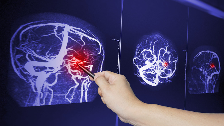 Scan of a traumatic brain injury