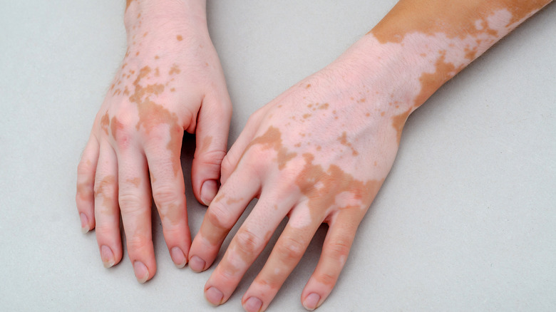 pair of hands with vitiligo 