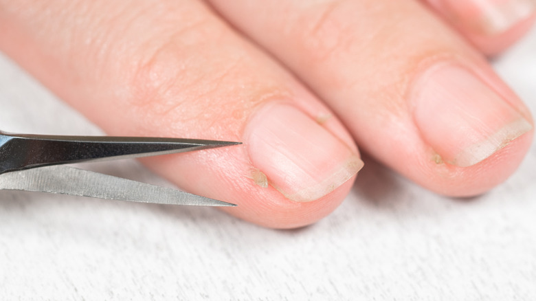 Scissors being used to cut off hangnail