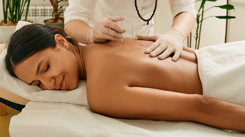 Woman getting acupuncture treatment