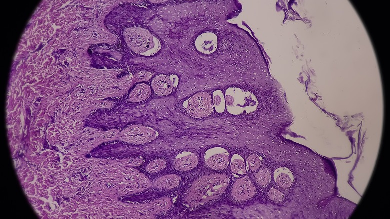 Endometrial scar tissue under microscope