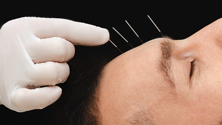 Acupunture on forehead