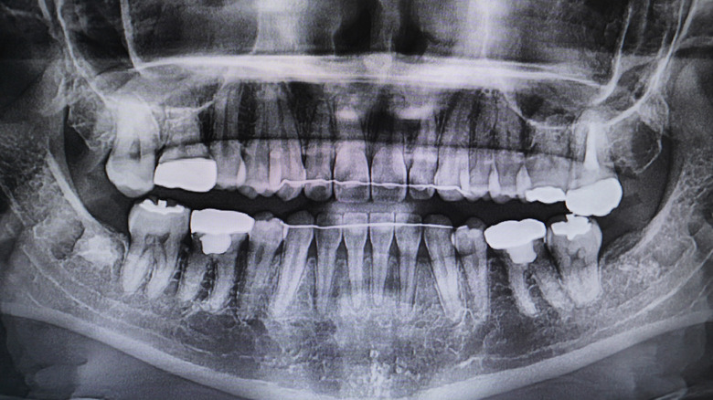 x-ray of teeth with permanent retainers