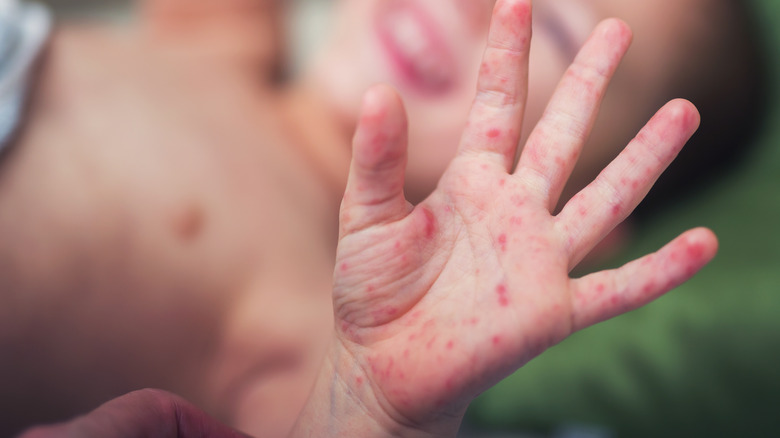 boy with symptoms of hand, foot, and mouth disease
