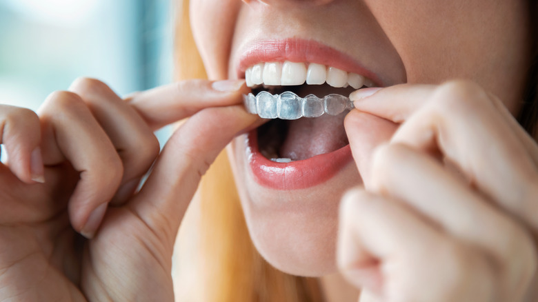 A woman puts in a teeth whitening tray