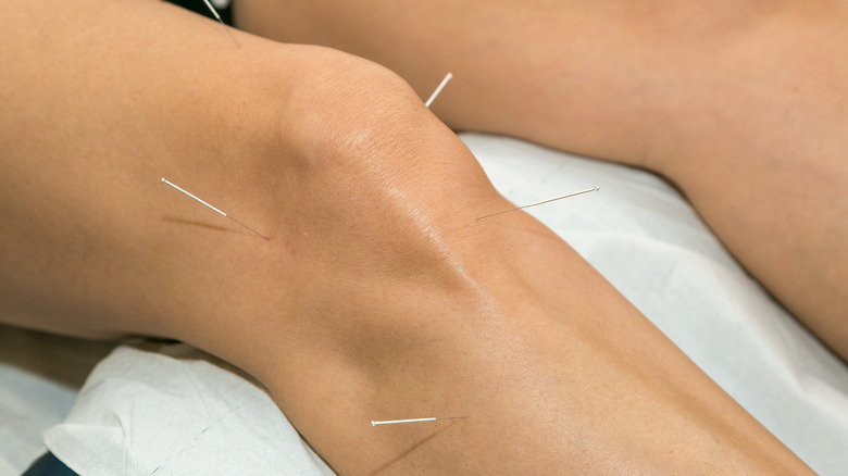 acupuncture for arthritis in knee