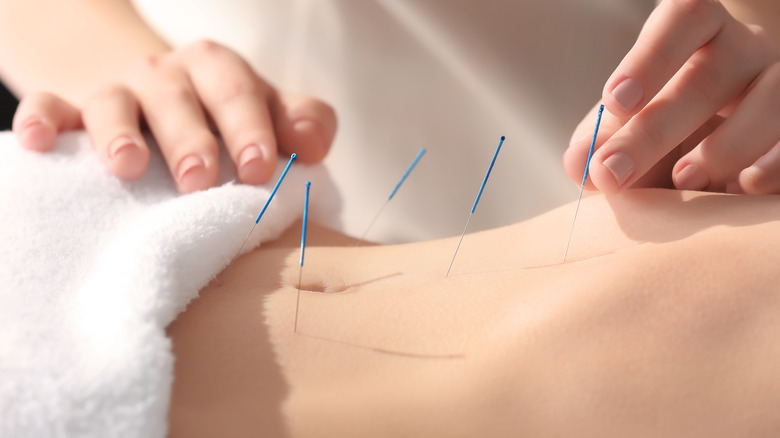 Woman with acupuncture needles in her stomach