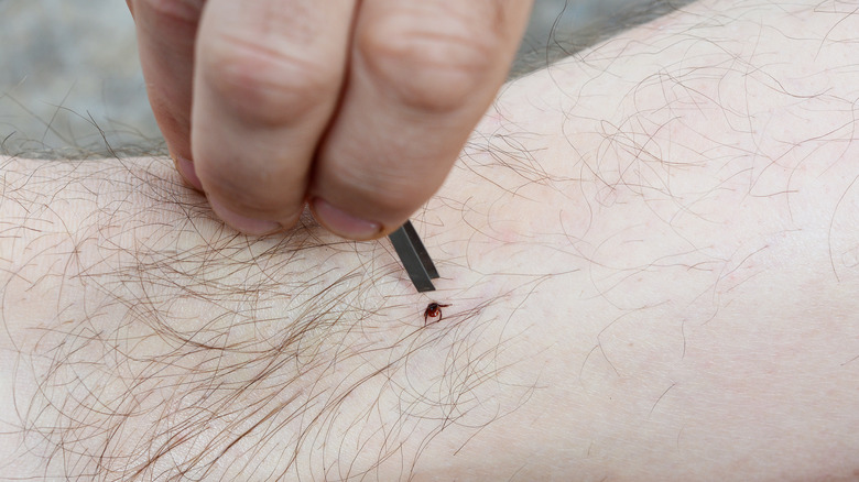 Person removing tick with tweezers