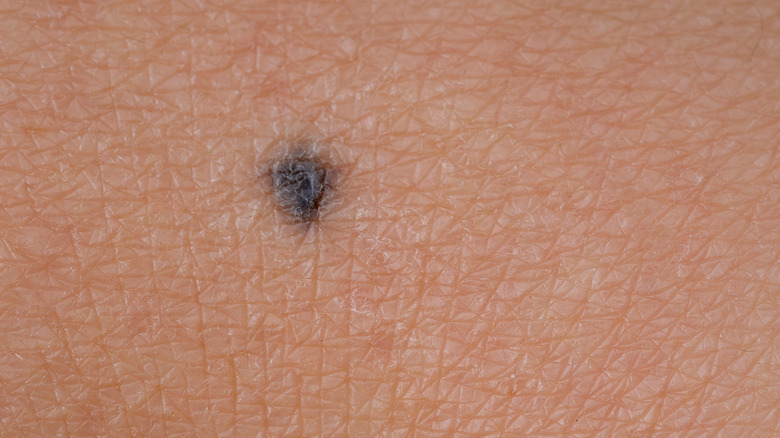 Blue nevus mole on skin