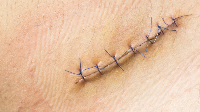 Close up of stitches on skin