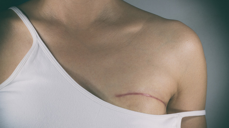 breast cancer surgery scar