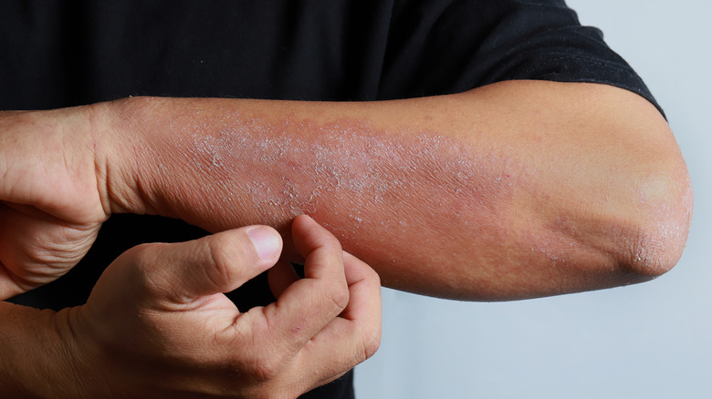 Man itching rash on his arm