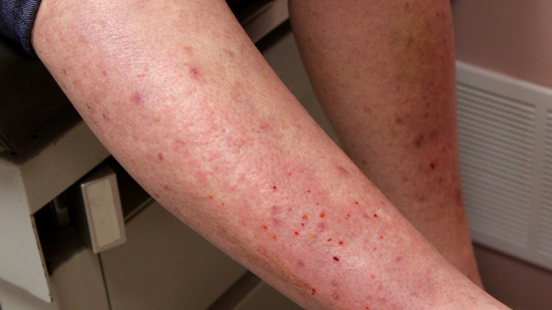 Image of a dermatitis herpetiformis rash